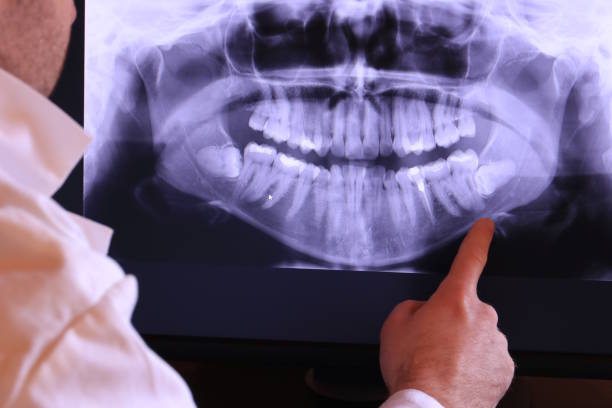 Best Emergency Tooth Extraction in Rush City, MN